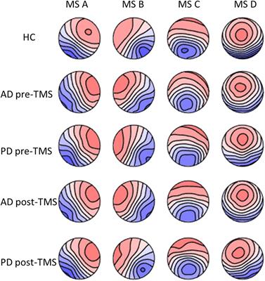 Therapeutic Role of Repetitive Transcranial Magnetic Stimulation in Alzheimer’s and Parkinson’s Disease: Electroencephalography Microstate Correlates